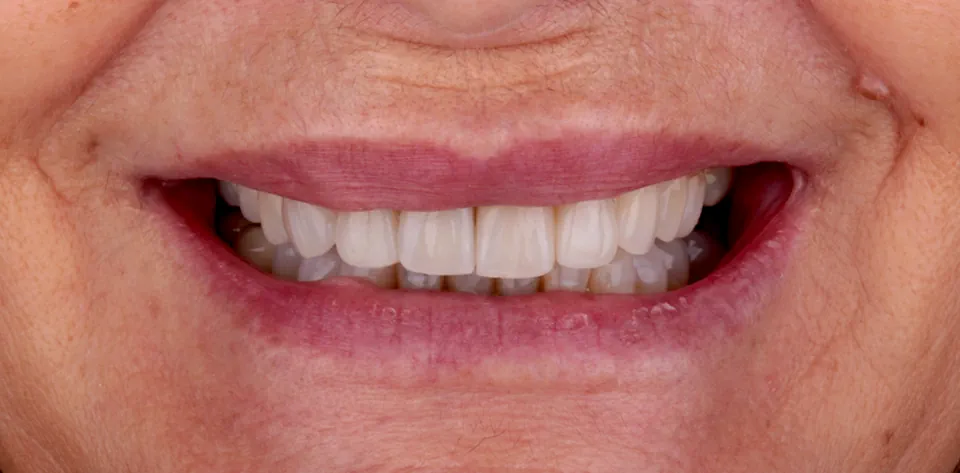 clinica-dental-gilbel-arques-caso-implante-dental-pc-5
