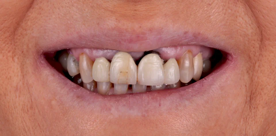 clinica-dental-gilbel-arques-caso-implante-dental-ppf-1