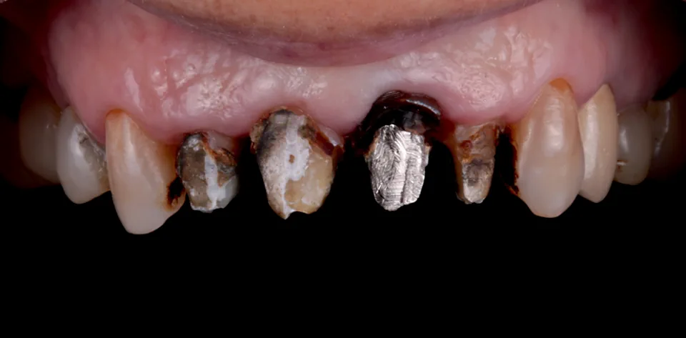 clinica-dental-gilbel-arques-caso-implante-dental-ppf-2
