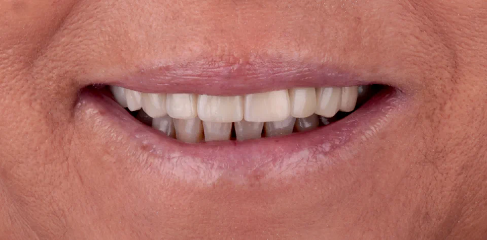 clinica-dental-gilbel-arques-caso-implante-dental-ppf-3