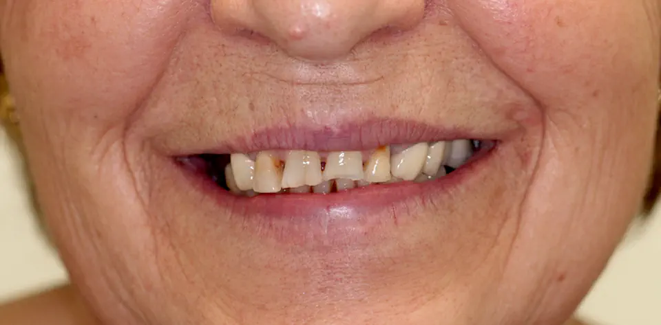 clinica-dental-gilbel-arques-caso-implante-dental-rlr-1