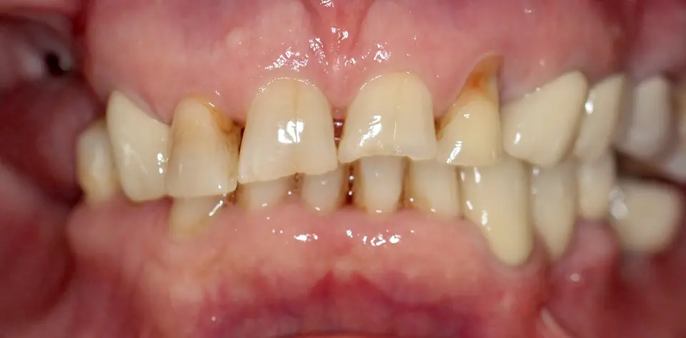 clinica-dental-gilbel-arques-caso-implante-dental-rlr-2