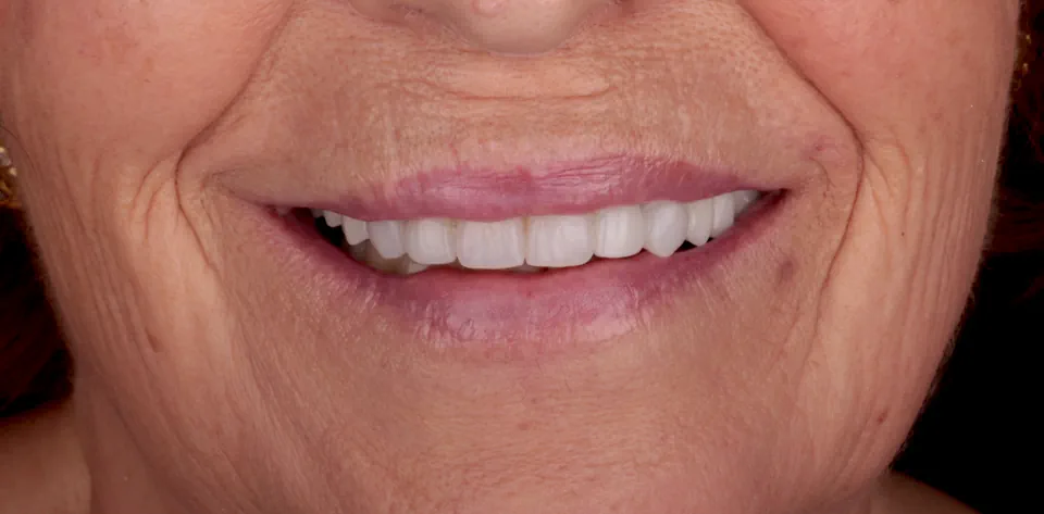 clinica-dental-gilbel-arques-caso-implante-dental-rlr-3