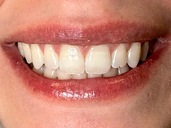 b-frontal