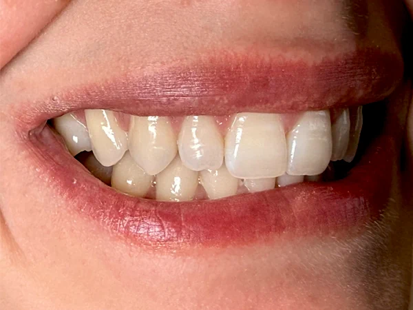 b-lateral-derecho