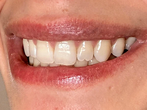 b-lateral-izquierdo