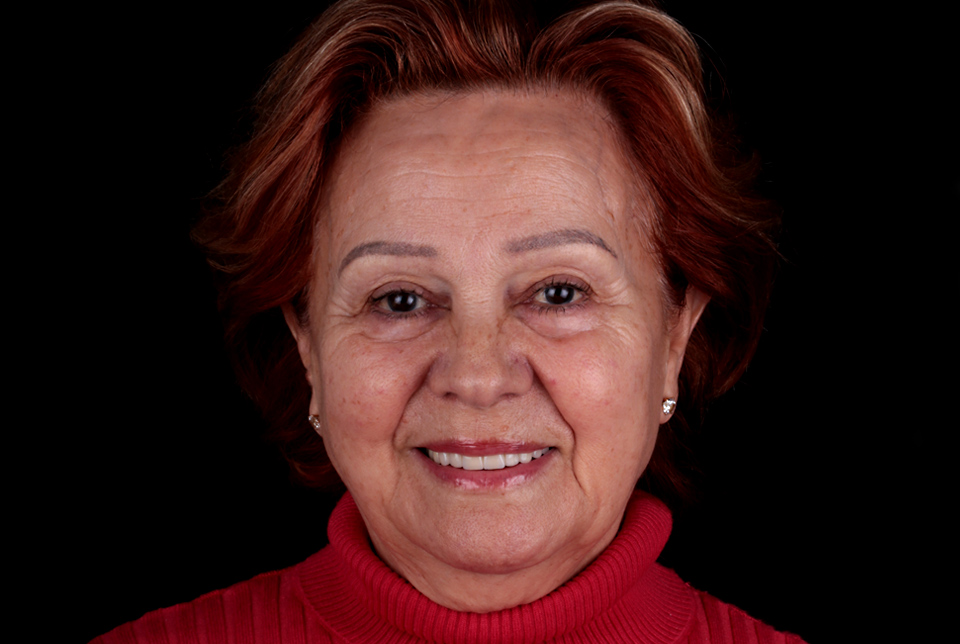 HD clinica-dental-gilbel-arques-caso-implante-dental-ecv-despues