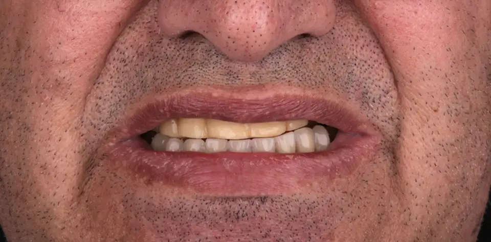 clinica-dental-gilbel-arques-caso-implante-dental-mbm-1