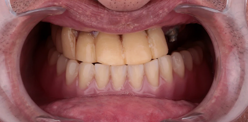 clinica-dental-gilbel-arques-caso-implante-dental-mbm-2