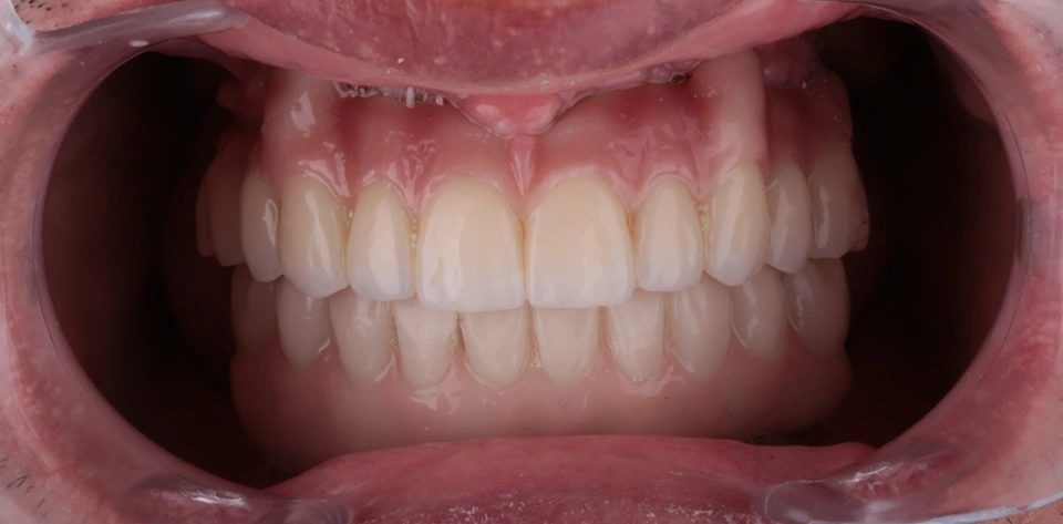 clinica-dental-gilbel-arques-caso-implante-dental-mbm-5