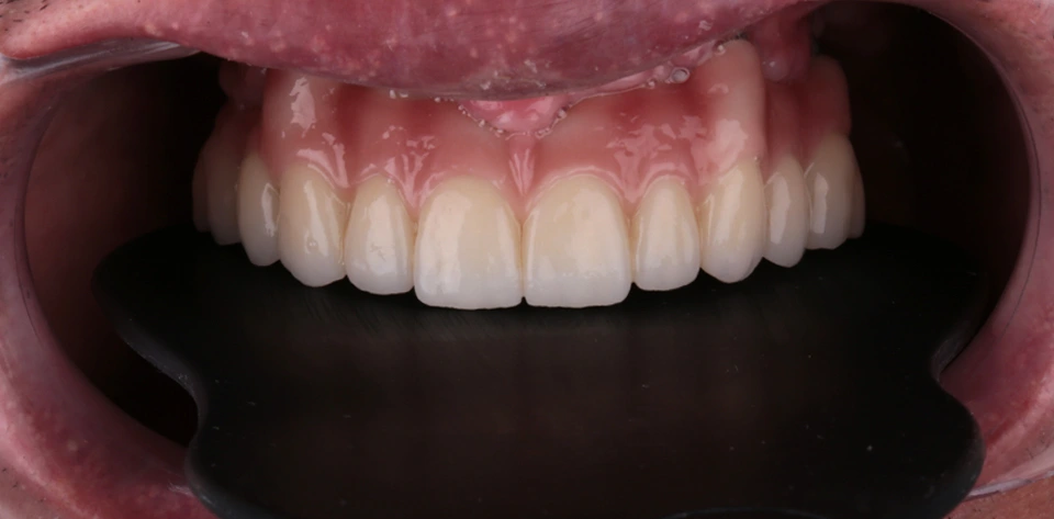clinica-dental-gilbel-arques-caso-implante-dental-mbm-6