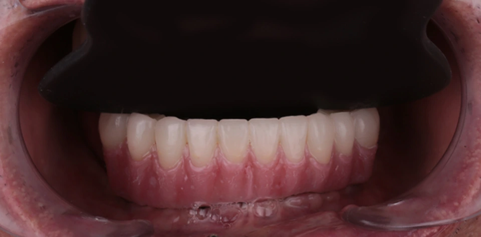 clinica-dental-gilbel-arques-caso-implante-dental-mbm-7