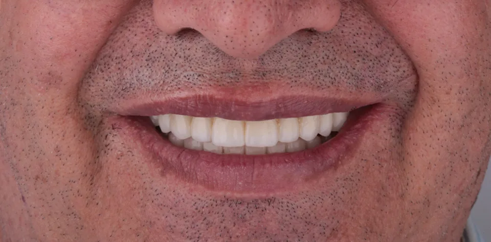 clinica-dental-gilbel-arques-caso-implante-dental-mbm-8