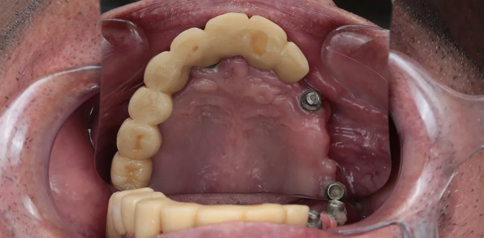 clinica-dental-gilbel-arques-caso-implante-dental-mbm-intraoral-3