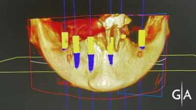 Cirugía Bucal – Aumento de hueso para rehabilitación con implantes dentales